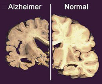 Servizi Sociali: Sabato 18 giugno alla gran guardia il convegno sull’alzheimer