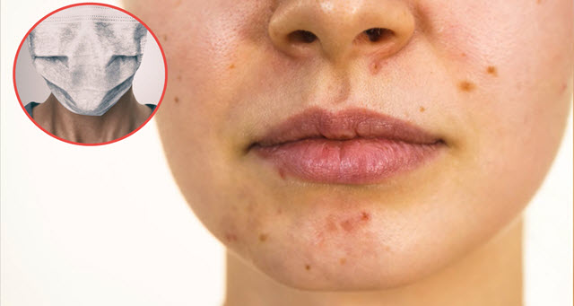 Caldo, mascherine e gel. Il consiglio del farmacista per tutelare la pelle